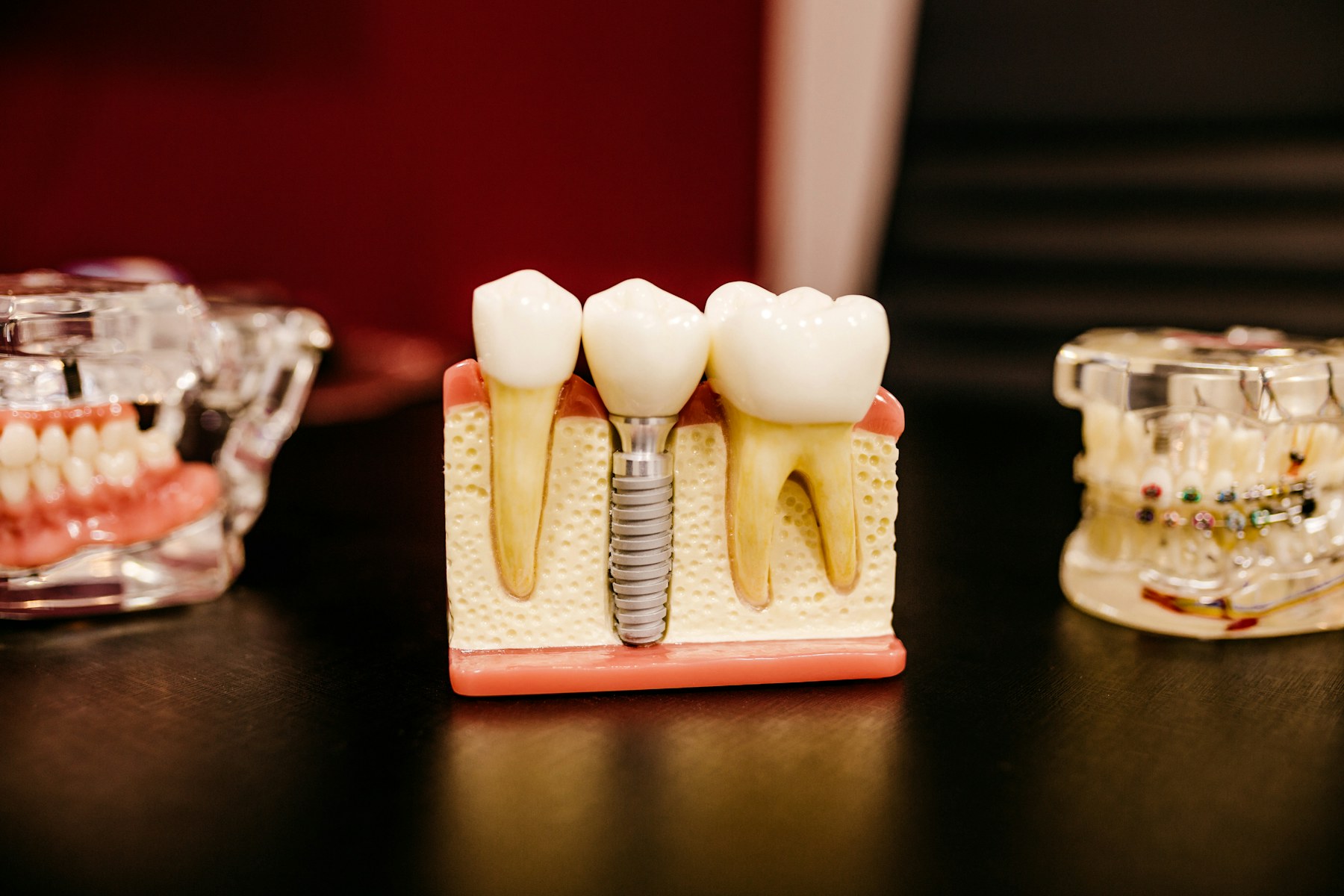 Close-up dental model showing a titanium implant fixture supporting a crown